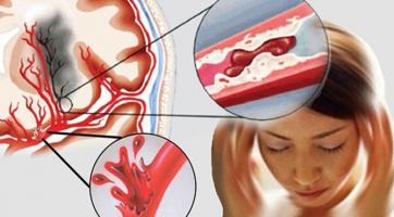 Thực phẩm chức năng phòng chống đột quỵ hiệu quả nhất hiện nay