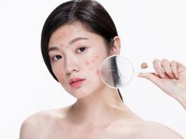 Kinh nghiệm đi trị mụn tại Phòng khám Da Liễu Hà Nội