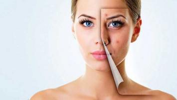 Bí quyết trị vết thâm mụn hiệu quả nhất từ thiên nhiên