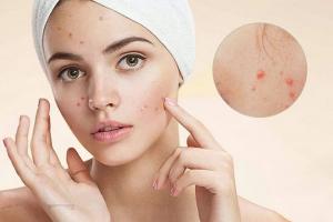 Spa trị mụn hiệu quả nhất quận Hai Bà Trưng, Hà Nội