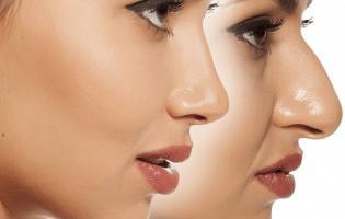 Địa chỉ nâng mũi đẹp và an toàn nhất TP. Vinh, Nghệ An