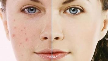 Địa chỉ trị thâm uy tín nhất tỉnh Nghệ An