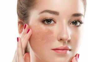 Loại kem trị nám và tàn nhang hiệu quả cao giá dưới 1 triệu đồng