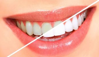 Địa chỉ tẩy trắng răng tốt và hiệu quả nhất tại TP. Vinh