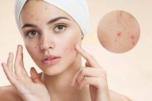 Spa trị sẹo rỗ do mụn uy tín nhất tại Vũng Tàu