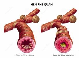 Dấu hiệu của bệnh hen suyễn bạn cần chú ý