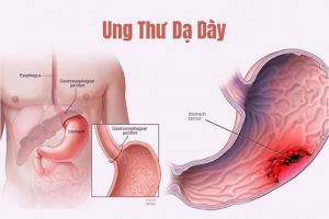 Xét nghiệm ung thư dạ dày phổ biến nhất hiện nay