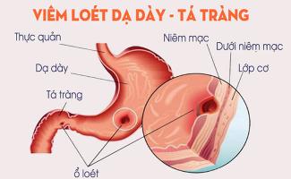 Bệnh lý thường gặp nhất ở dạ dày mà bạn cần biết để phòng tránh